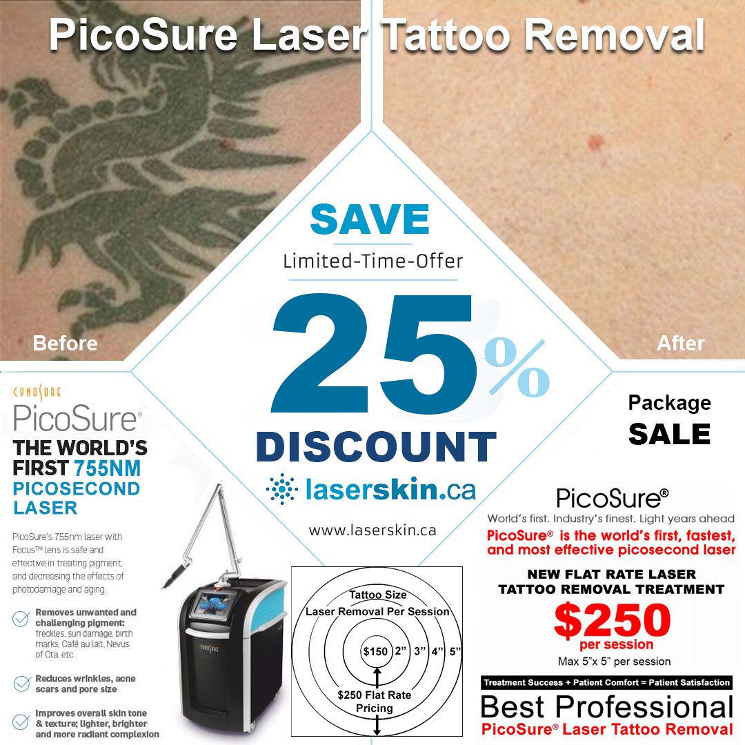 laser tattoo removal cost Toronto