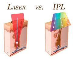 laser-vs-ipl bikini laser hair removal