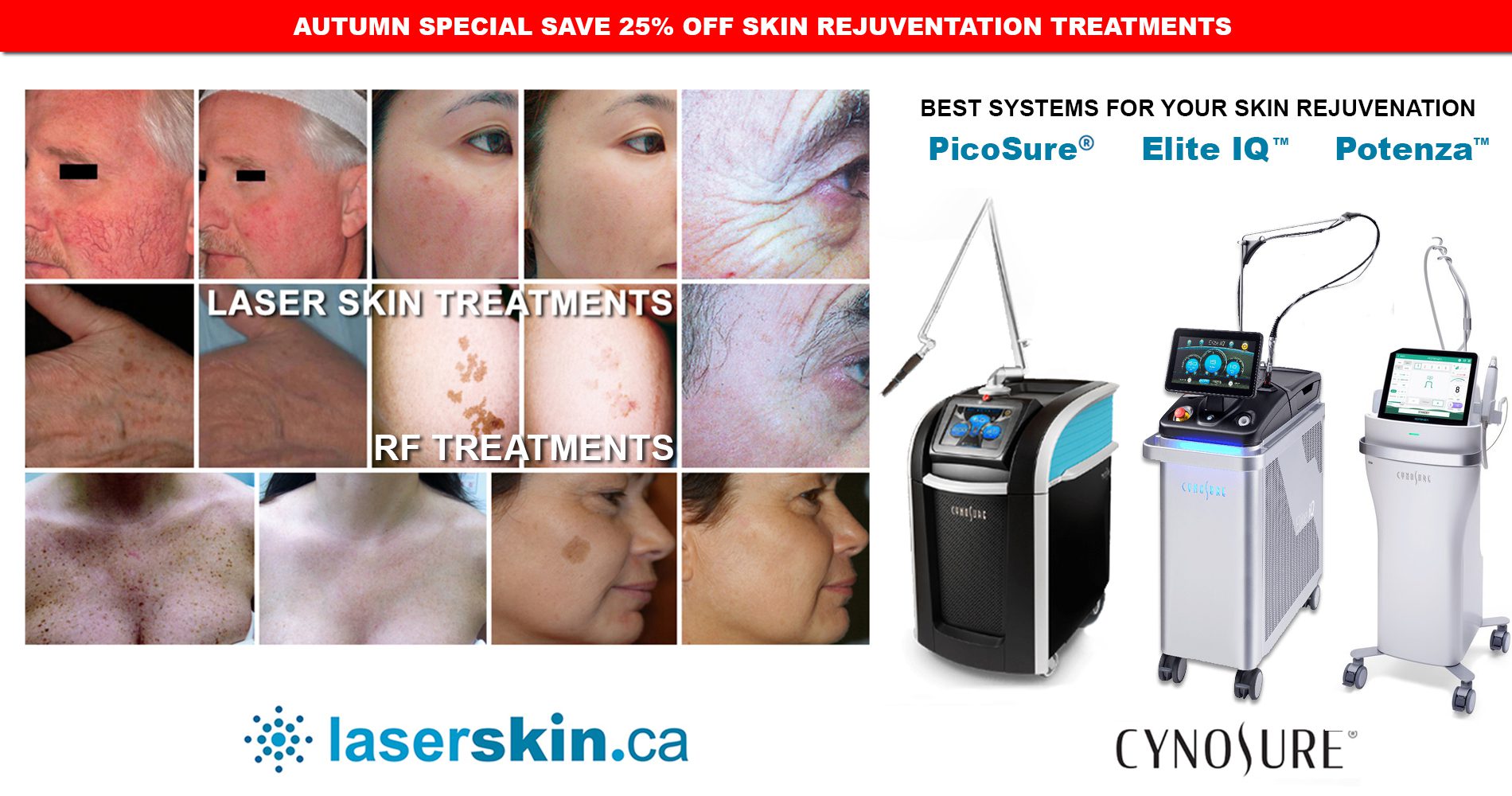 freckles removal treatment Toronto