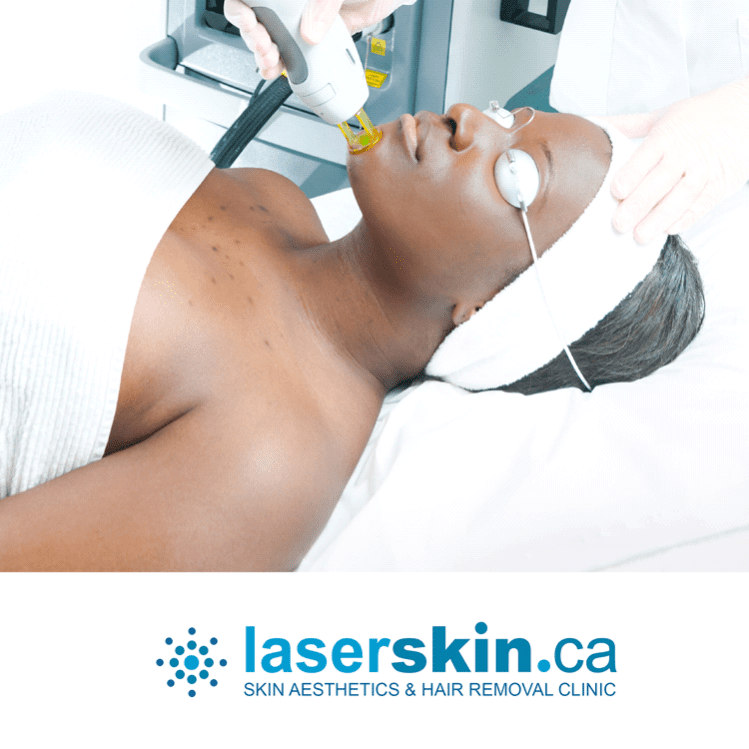 Laser treatment for hair deals removal cost