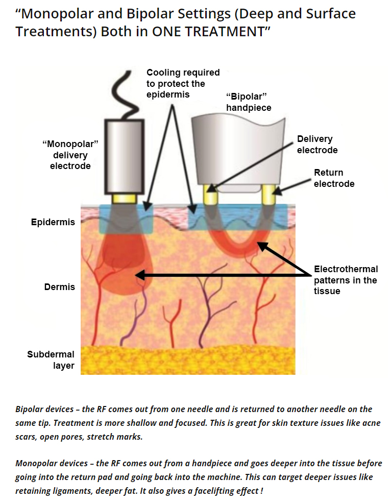 radio frequency skin tightening using potenza rf microneedling Toronto