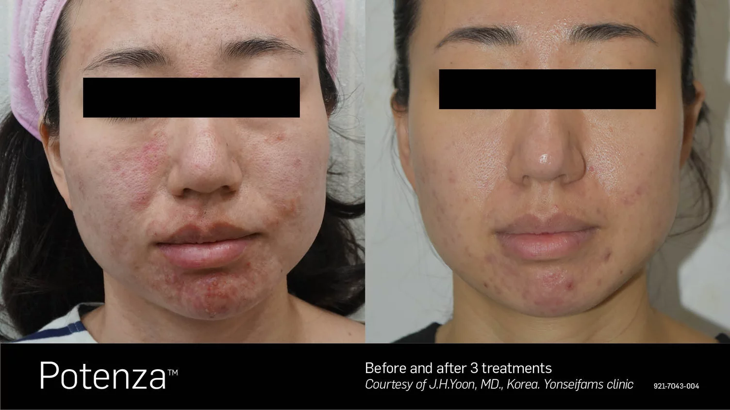 rf skin tightening