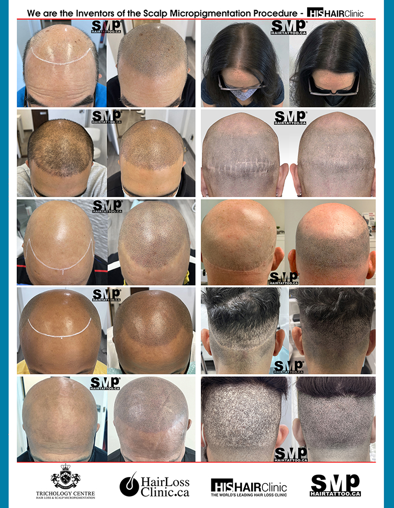 scalp micropigmentation for women
