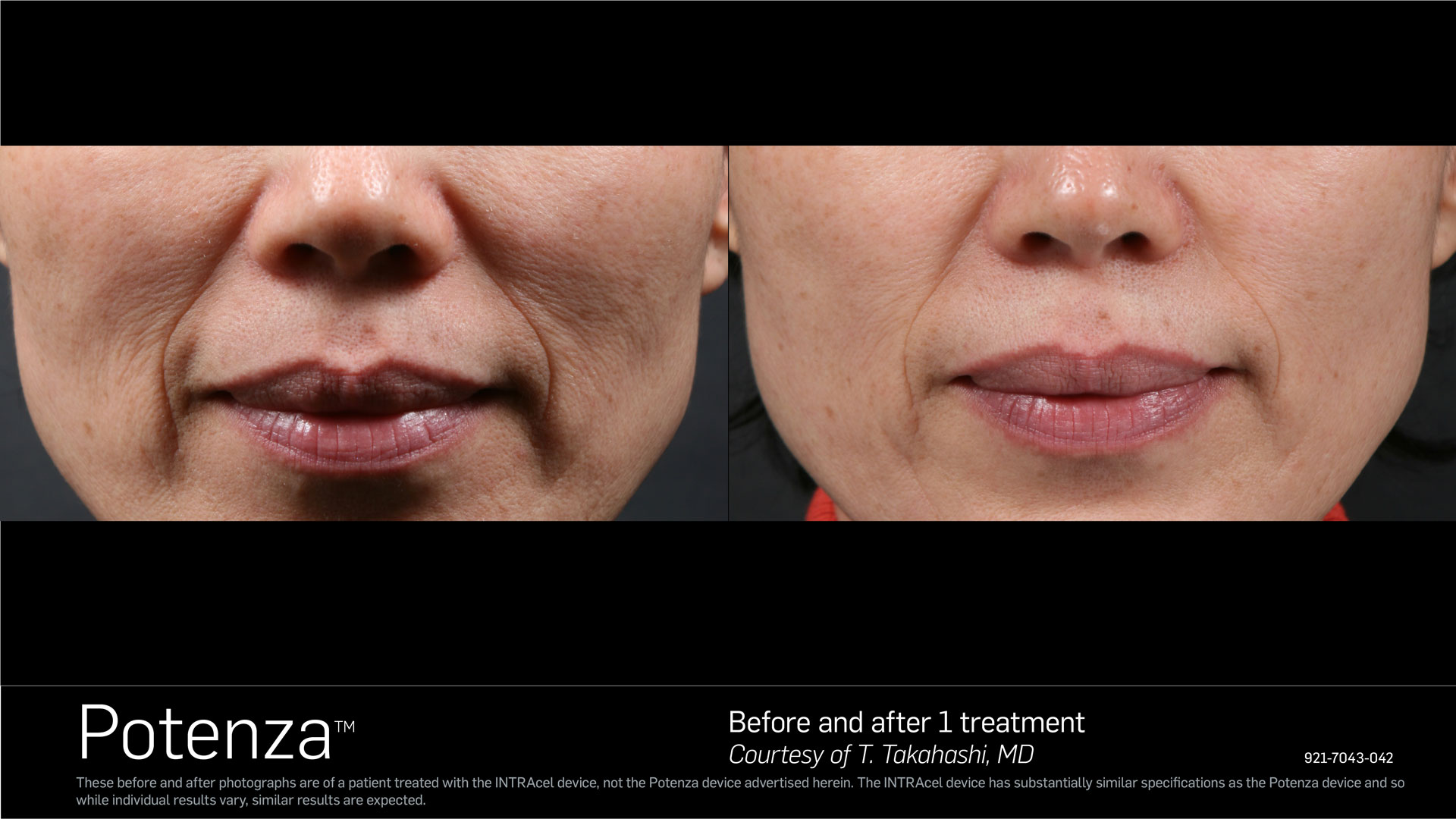 Microneedling Before and After 1 Treatment