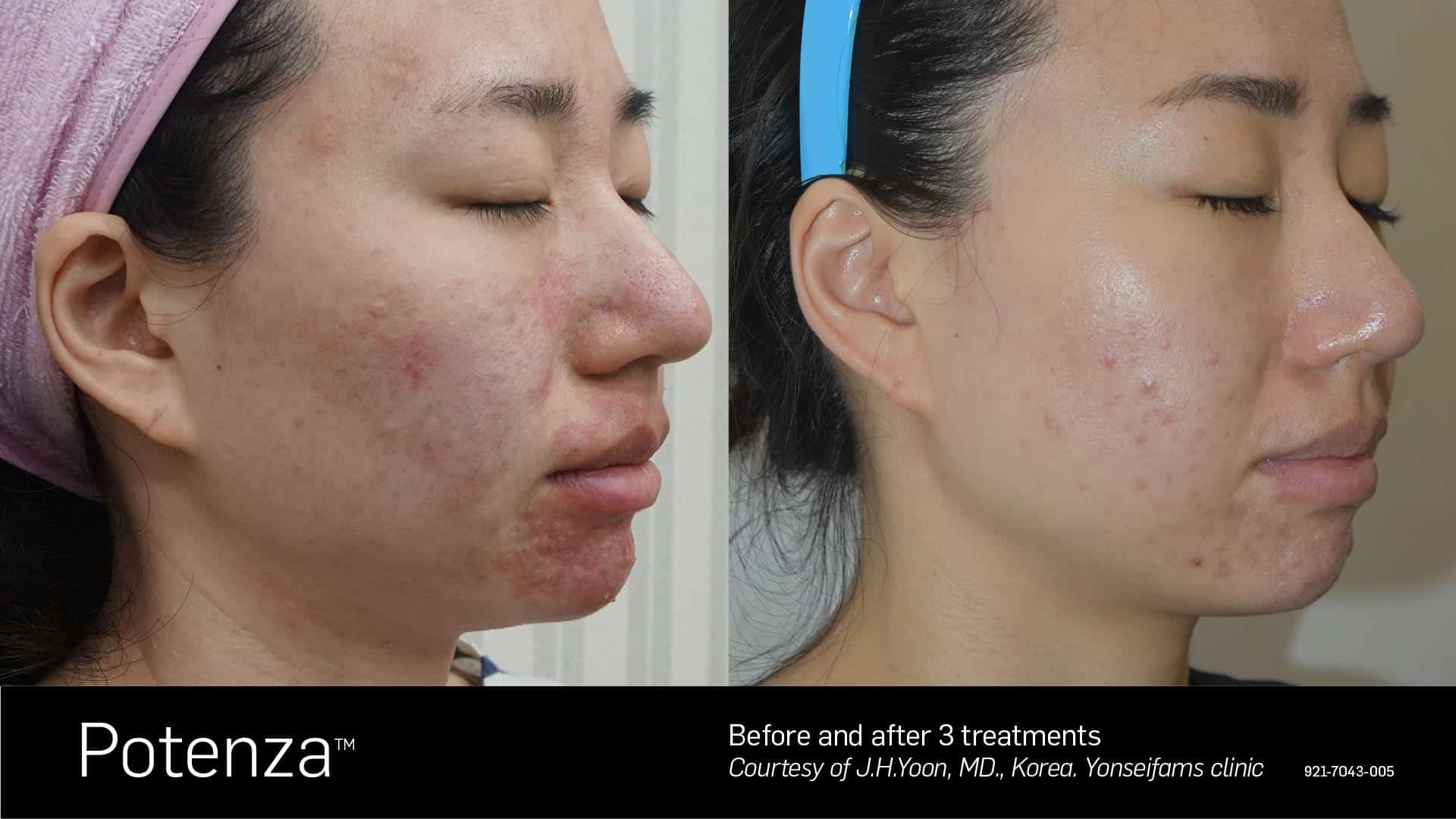 Potenza Acne Treatment Toronto Before and After (2)