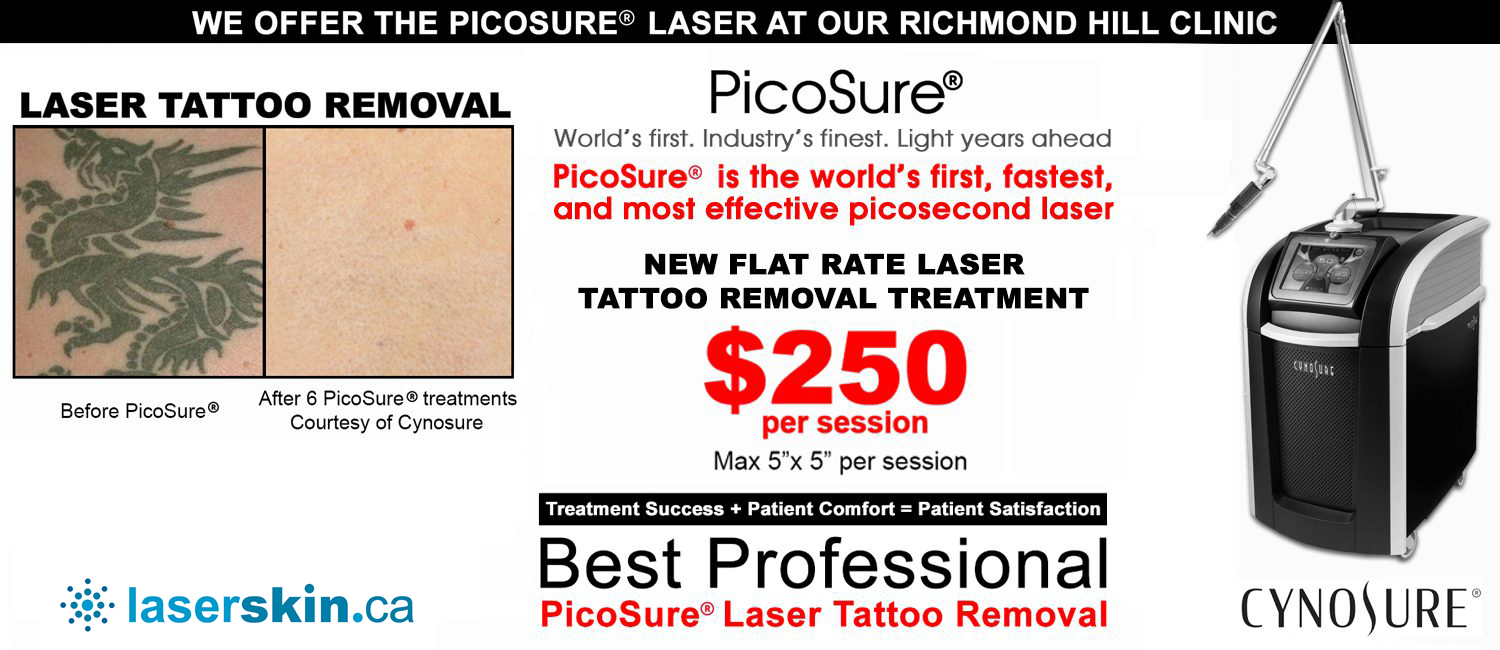 Tattoo Laser Removal - Toronto