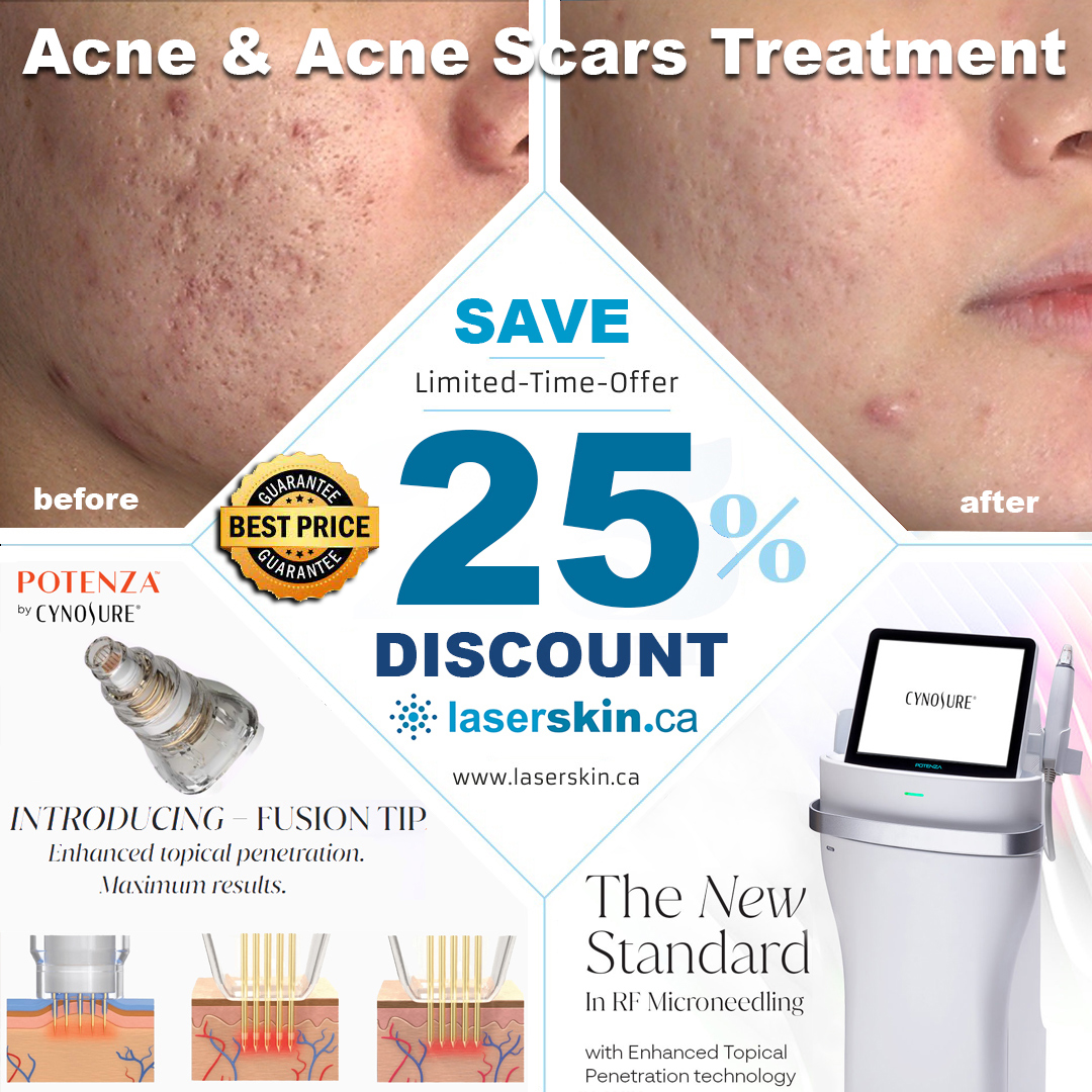 acne scar treatment - acne scars treatment