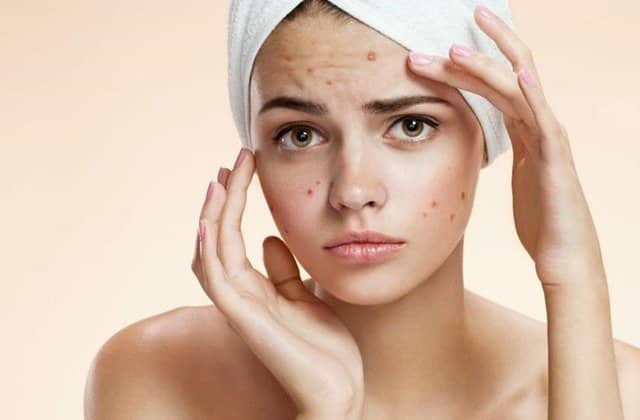 acne treatment Toronto