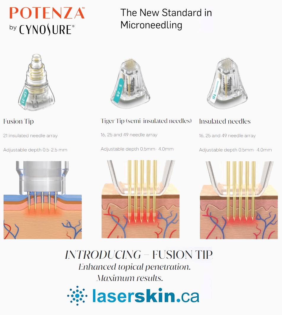 best microneedling Toronto ON