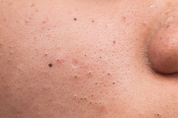 blackheads-acne scars-acne scars treatment Toronto