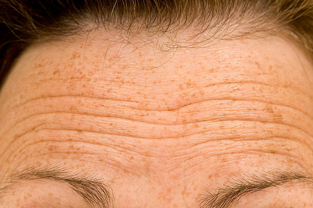 forehead wrinkles treatment