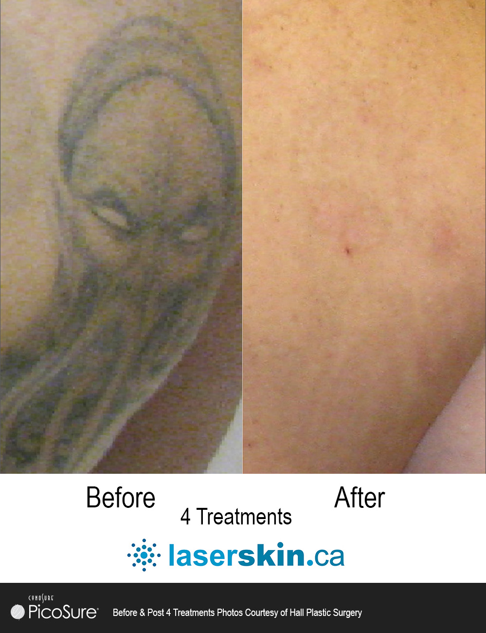 laser tattoo removal Toronto (1)