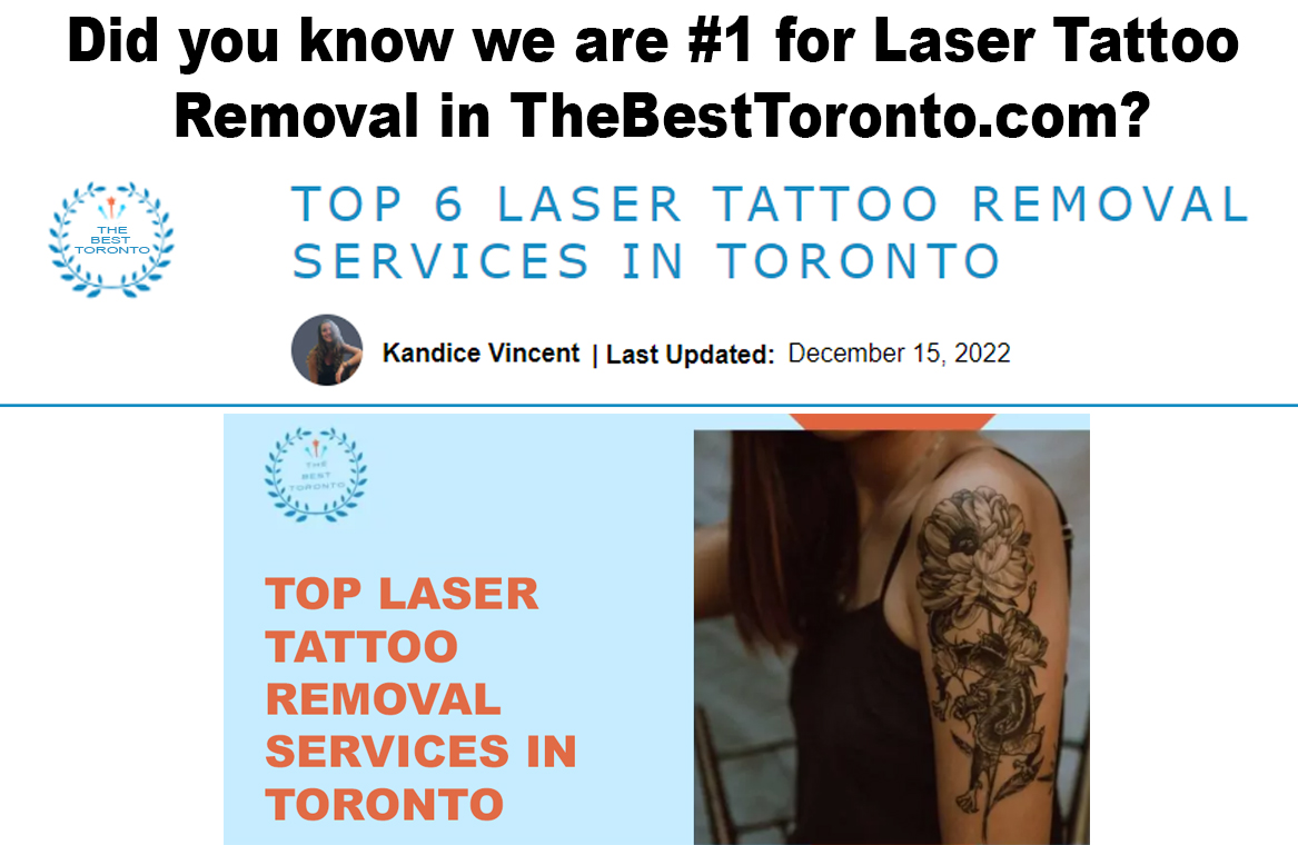 laser tattoo removal Toronto - thebesttoronto.com