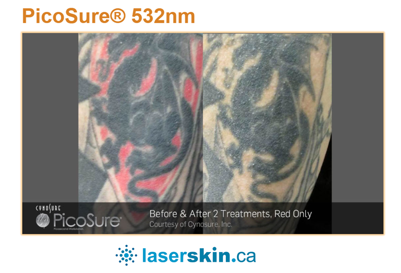 laser tattoo removal before and after (1)