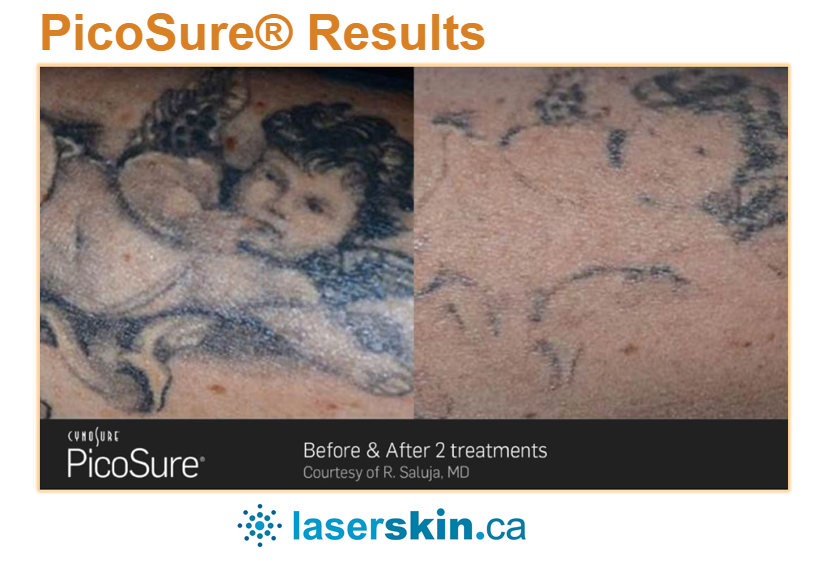 laser tattoo removal before and after (2)