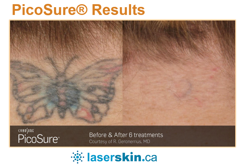 https://laserskin.ca/wp-content/uploads/2022/12/laser-tattoo-removal-before-and-after-3.png