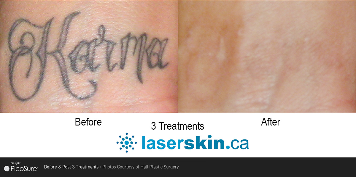laser tattoo removal before and after (4)