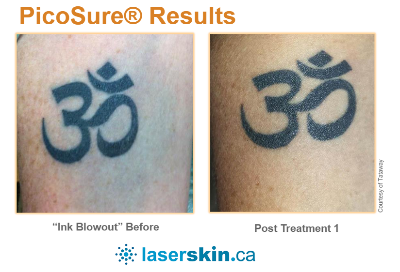 laser tattoo removal before and after (5)