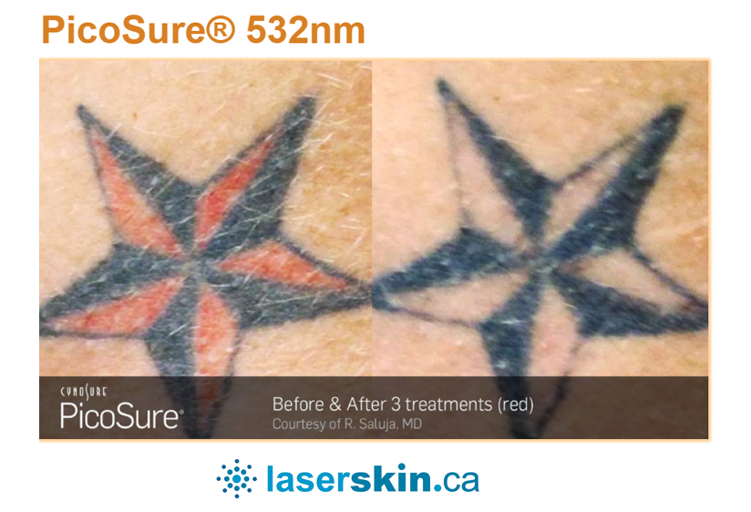 laser tattoo removal before and after (6)