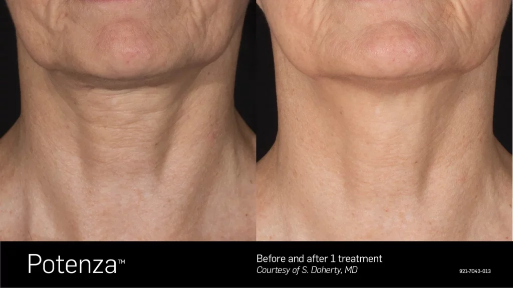 microneedling before after (2)