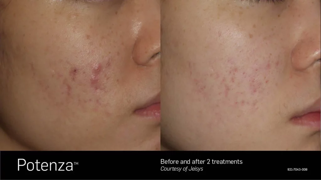 microneedling before and after (1)