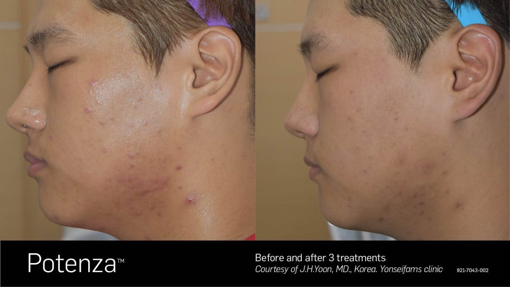 microneedling before and after
