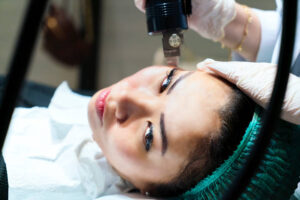 microneedling for acne scars - toronto