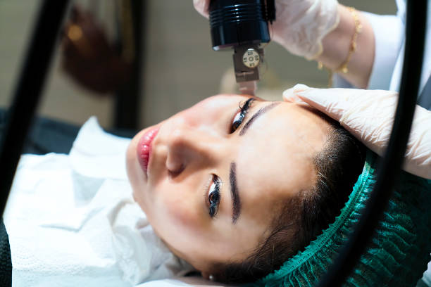 Microneedling for Acne Scars