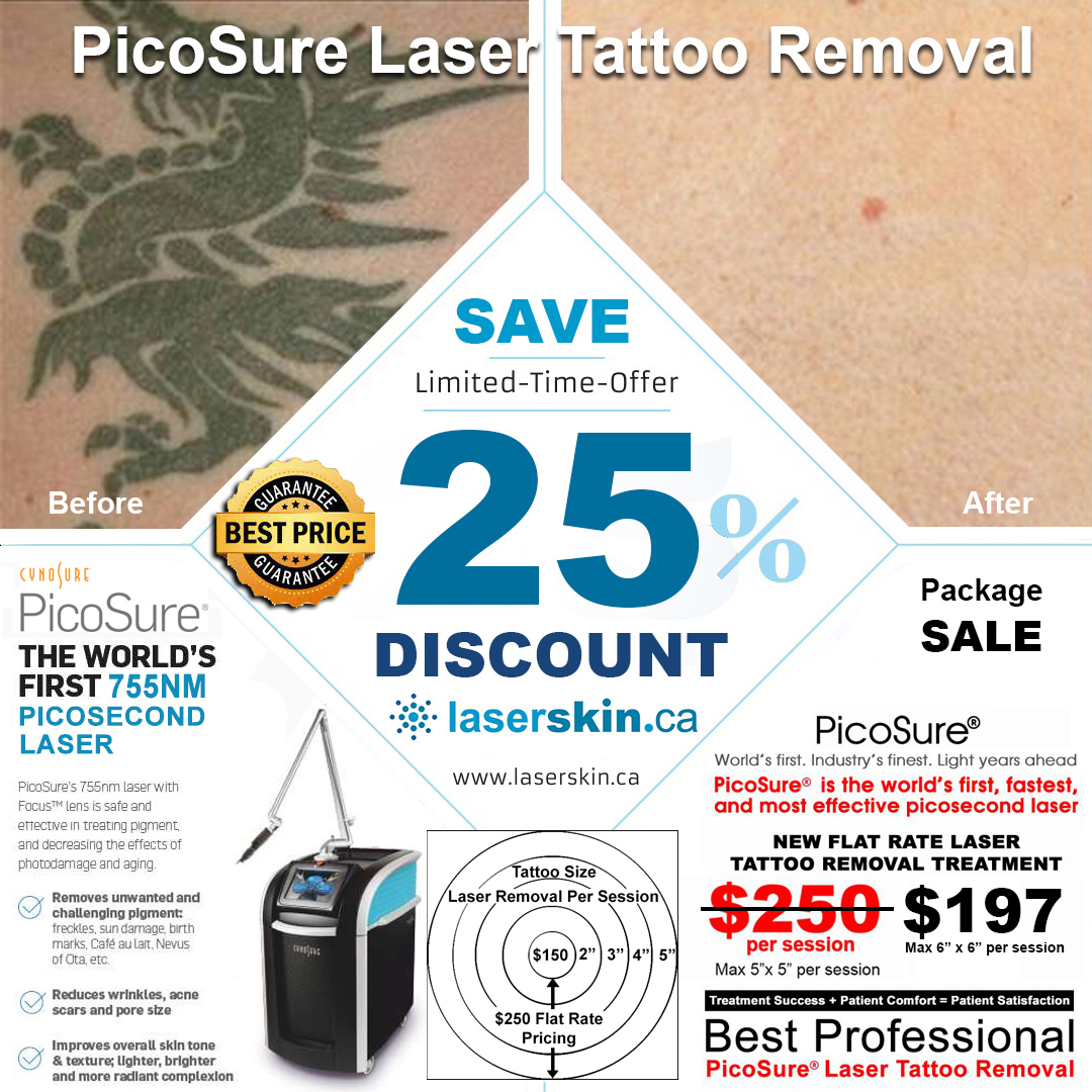 picosure-laser-Toronto-laser-tattoo-removal-Toronto