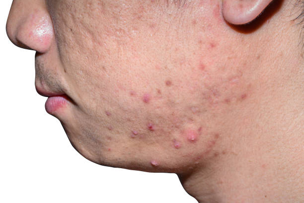 picosure laser for acne scars