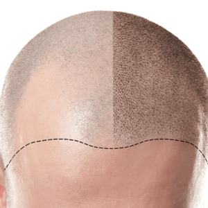 scalp micropigmentation - hair tattoo