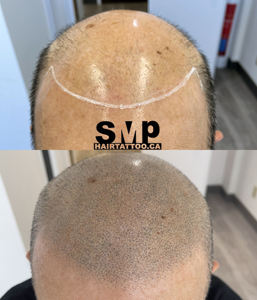 scalp micropigmentation - hair tattoo