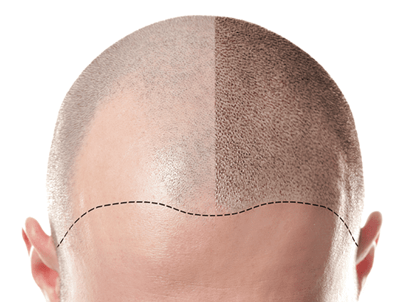 scalp micropigmentation - hair tattoo