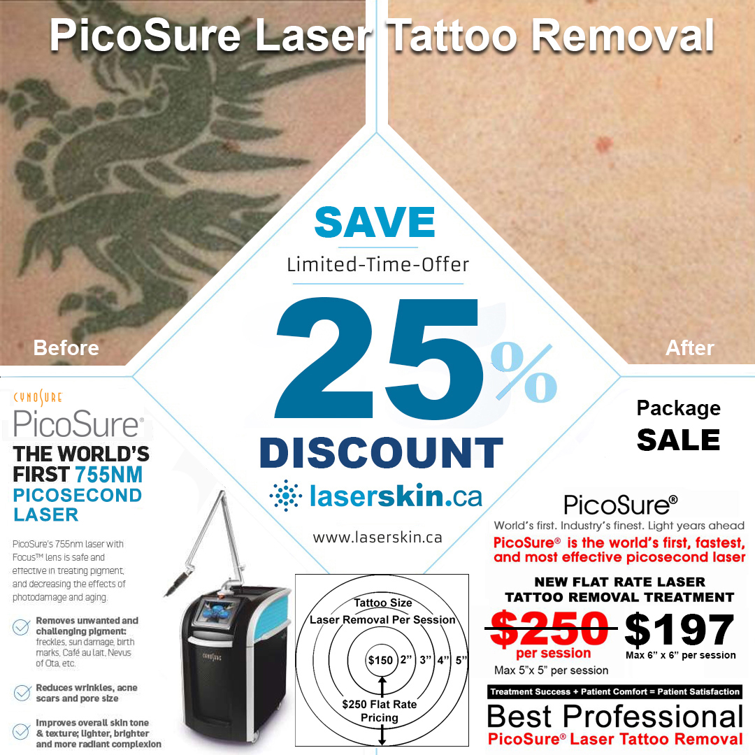 tattoo removal Toronto (2)