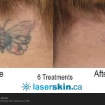 tattoo removal before after (1)