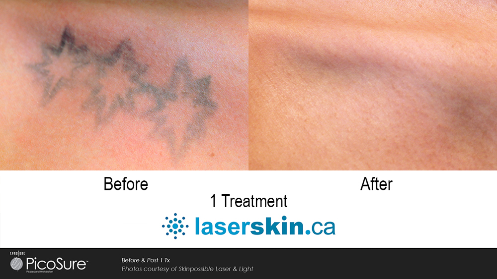 tattoo removal before after (2)