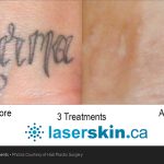 tattoo removal before after (3)