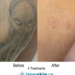 tattoo removal before after (4)