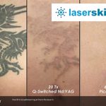 tattoo removal before after (5)