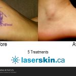 tattoo removal before after (6)