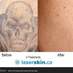 tattoo removal before after (7)