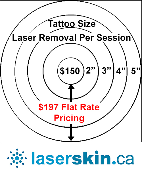 laser-tattoo-removal-cost