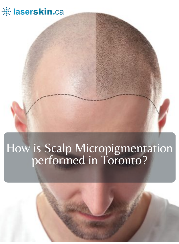 How is Scalp Micropigmentation performed in Toronto?