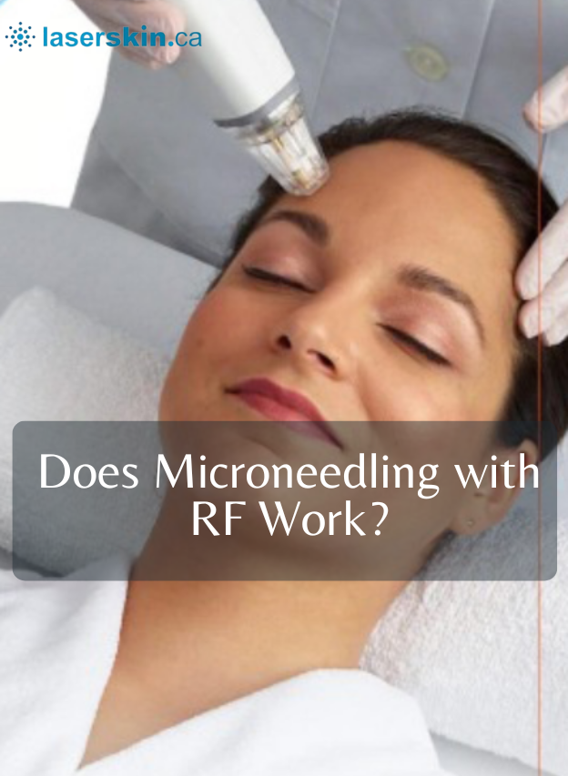 Does Microneedling with RF Work?