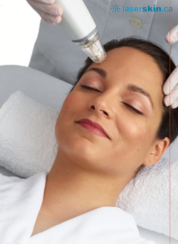 An Ultimate Guide to Know More About RF Microneedling