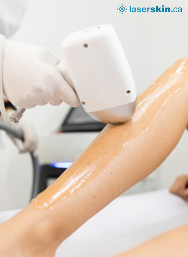 Laser Hair Removal In Toronto? Here Is What You Should Know