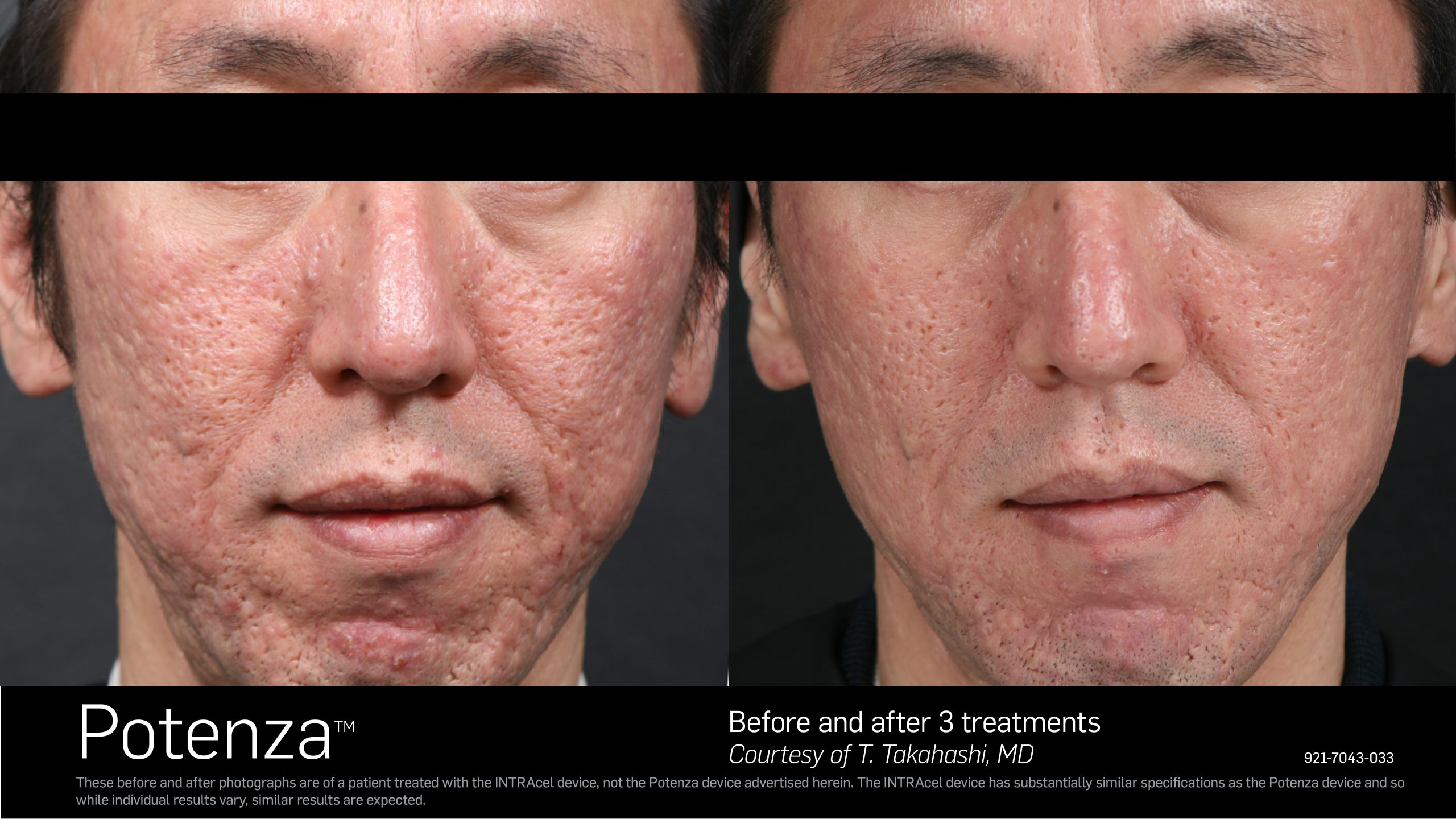 Transformative Results: Microneedling Before After  LASERSKIN.CA