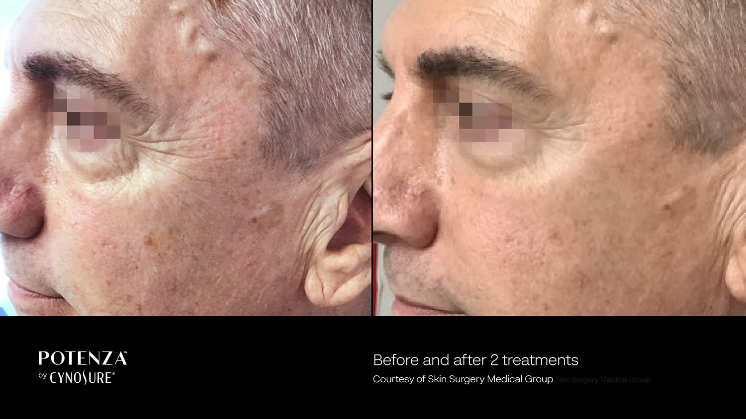 Potenza RF Microneedling Before and After Toronto ON