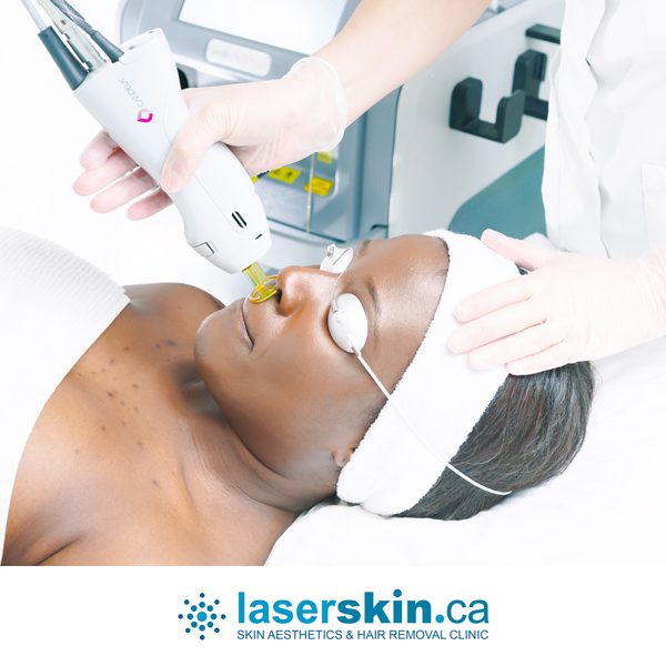 best laser hair removal Toronto