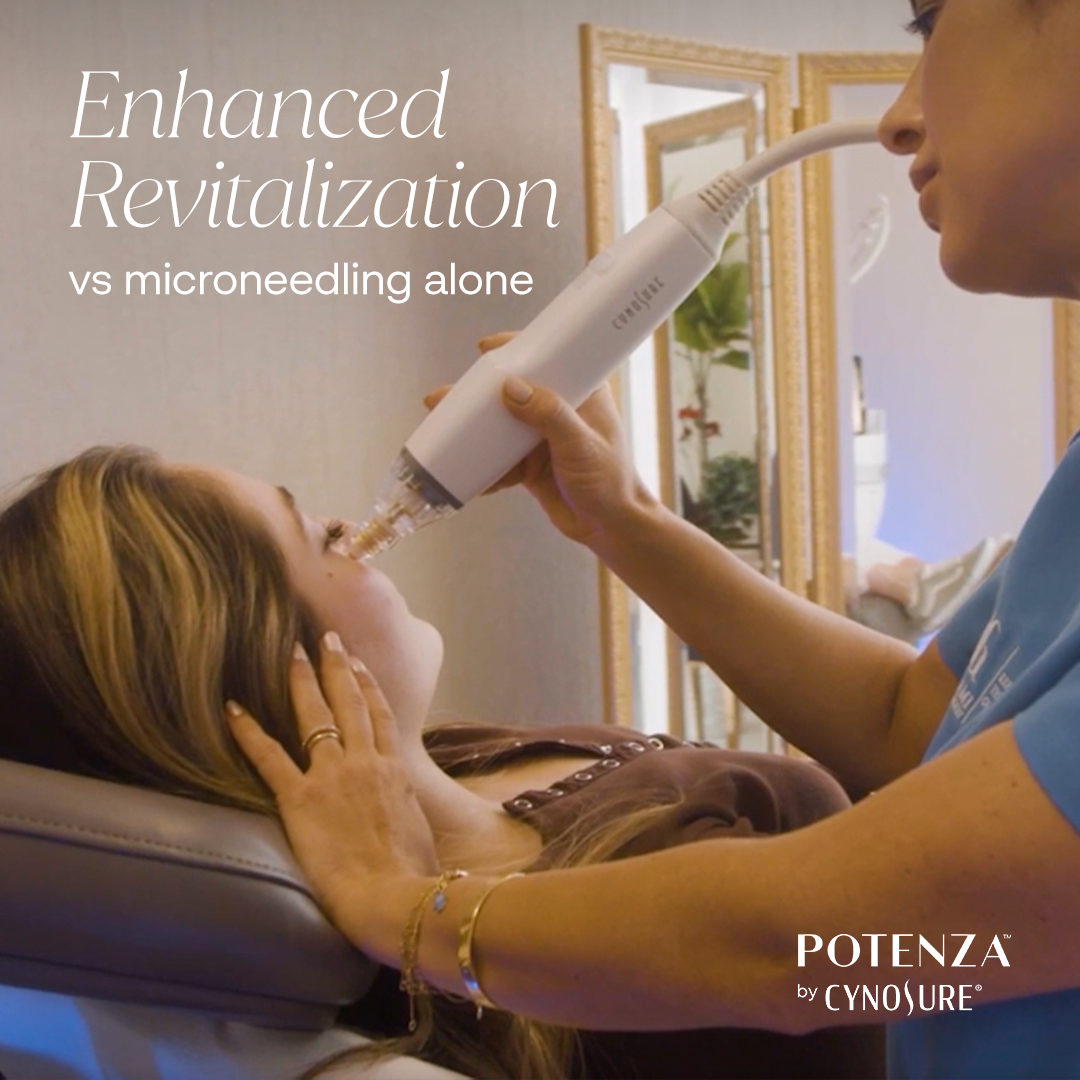 potenza radiofrequency microneedling